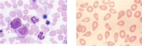 Lecture Myeloproliferative Disorders Flashcards Quizlet