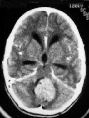 Medulloblastoma Imaging: Practice Essentials, Computed Tomography ...