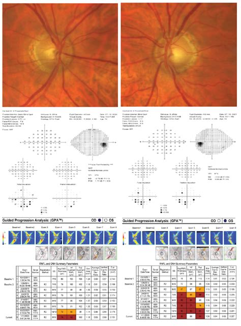 Iop Pachymetry Conversion Chart Iop Corneal Actual Correspon