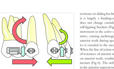 Types Of Tooth Movement A Uncontrolled Tipping B Controlled