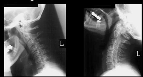 Cervical Spine Flexion And Extension Diagram Quizlet