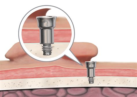 BAHA/BAHS surgery | Ear Community