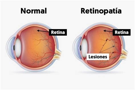 C Mo Se Clasifica La Retinopat A Diab Tica S Ntomas Y Tratamiento