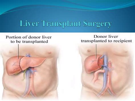 Cost Of Liver Transplant Surgery In India Ppt