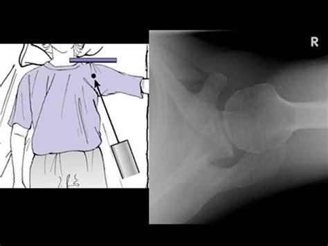 Outlet View Of Shoulder Joints | semashow.com