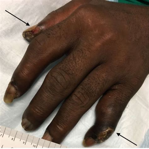 Two Digits Of Left Hand Showing Dry Gangrene With No Evidence Of