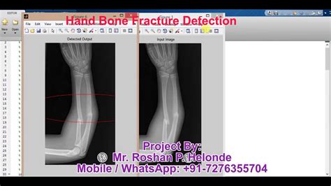 Matlab Code For Hand Bone Fracture Detection Using Image Processing