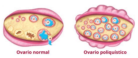 Sop Y Fertilidad C Mo Afecta Al Embarazo