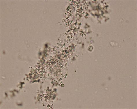 What are the types of Crystals found in Urine?