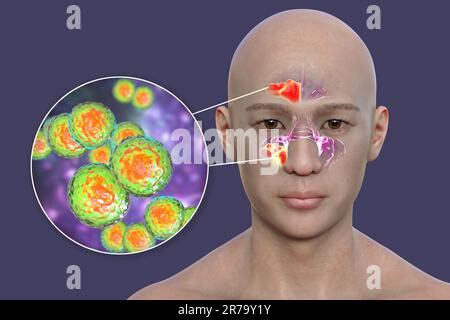 Anatomy Of Rhinosinusitis And Bacteria That Cause Sinusitis