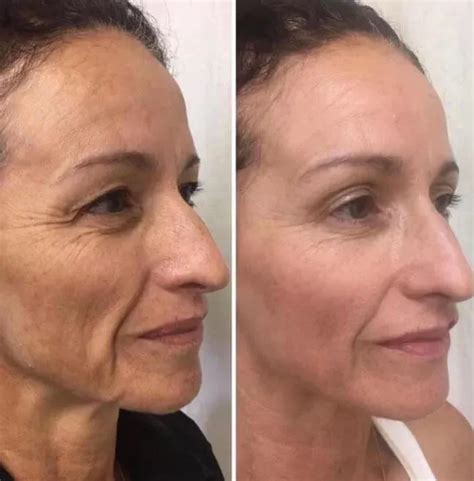 Sagging Skin Face Facial Before And After Dermapen Facial Tissues