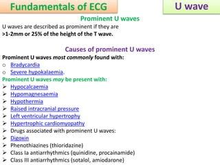 Approach to a patient with U wave in ECG | PPT