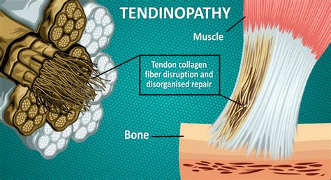 Tendinopathy i – Back In Action