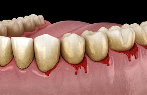 Common Signs Of Gum Disease Karrie Chu Dds Dental Care Pasadena California