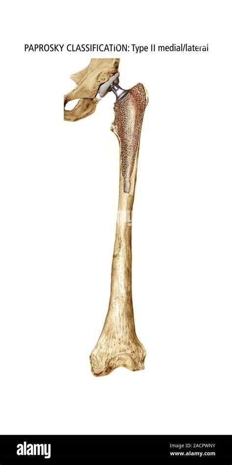 Paprosky Femur Defekt Cutaway Artwork Von Knochen Abbau In Einem Typ