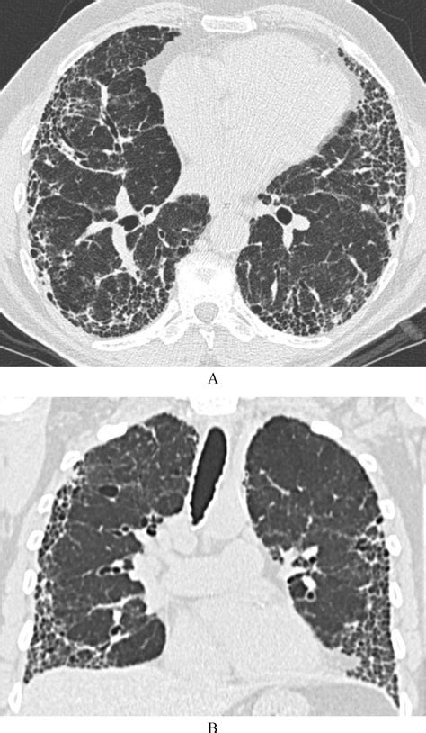 High Resolution Ct Scan Of A Year Old Man Exsmoker With Idiopathic