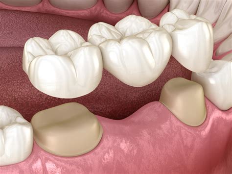 5 Dental Options For Replacing Missing Teeth Dental Arts San Diego Blog