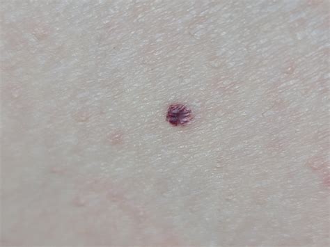 History of Melanoma in STIU. Cherry angioma, or something concerning