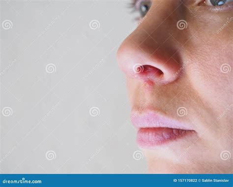 Herpes Under A Woman S Nose Close Up Stock Photo Image Of Female