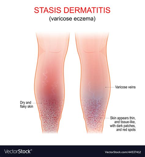 Varicose eczema symptoms of venous gravitational Vector Image