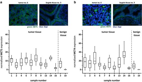 Monocarboxylate Transporter Mct 1 And Mct4 Expression In Benign And Download Scientific