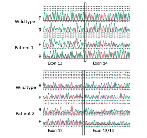 Sanger Sequencing Results Of The Rna Of Patient 1 Upper Panel And