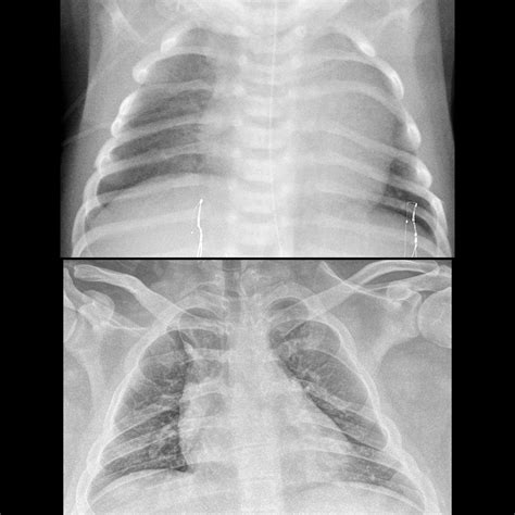 Pediatric Bifid Rib | Pediatric Radiology Reference Article | Pediatric