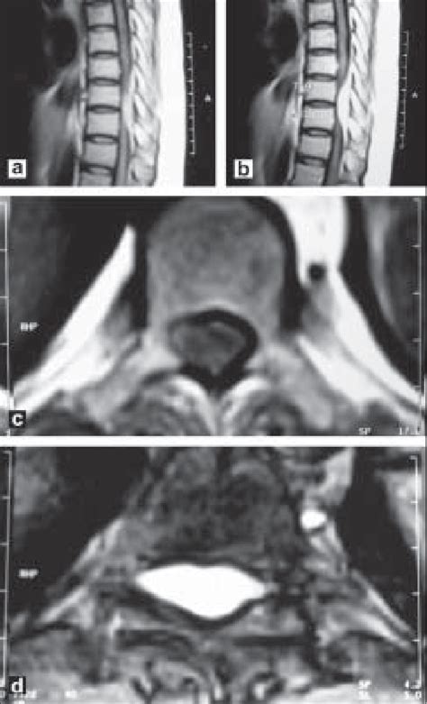 Figure From Spinal Epidural Cavernous Hemangioma With Myelopathy A