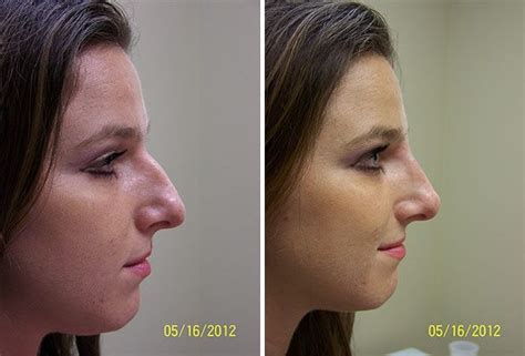 Non Surgical Rhinoplasty Richmond Cosmetic Clinic