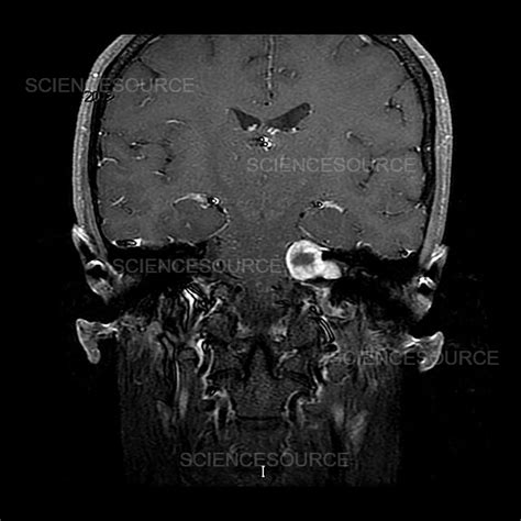 Photograph | Vestibular Schwannoma, MRI | Science Source Images