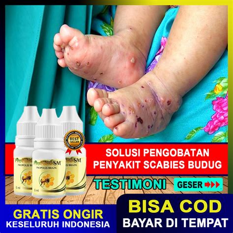 Obat Penghilang Bekas Budug Di Kaki Tangan Kulit Gatal Borok Scabies