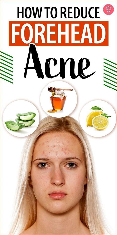 How to get rid of forehead acne 9 home remedies to try – Artofit