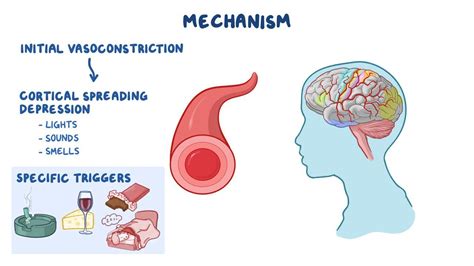 Migraine medications: Video, Anatomy & Definition | Osmosis