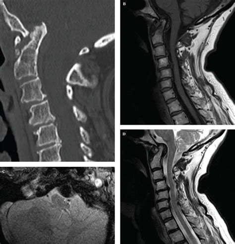 Rheumatoid Arthritis Mri