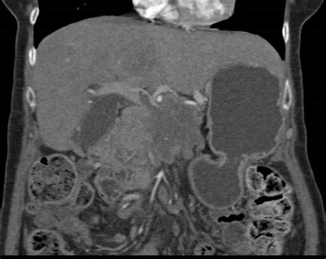 Pancreatic Adenocarcinoma Invades The Portal Vein And Superior