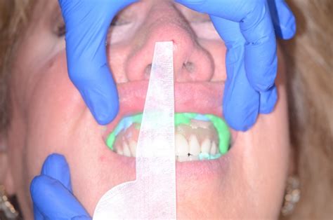 8 Considerations In Denture Relining Spear Education