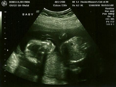 The Bonello Trio: 19 week ultrasound "It's a BOY