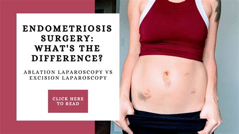 Endometriosis Surgery: Ablation laparoscopy vs Excision laparoscopy. What is the difference ...