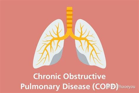 恶化风险降30 慢阻肺有望迎来首款生物疗法 知乎
