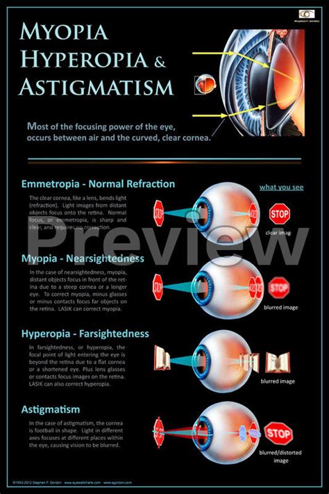 Myopia, Hyperopia & Astigmatism Poster – Eye Flip Charts by Stephen F ...