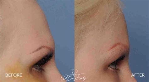 Aesthetic Forehead Surgery Dr Barry L Eppley