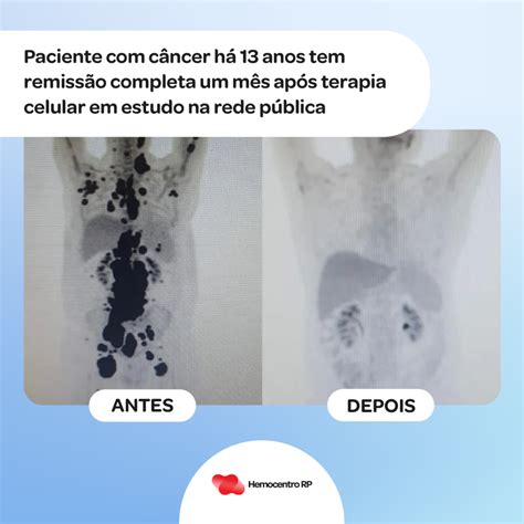 Terapia experimental células CAR T alcança remissão em paciente