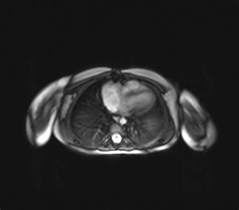 Cardiac Mri 6 Months After Tumor Resection That Showed No Residual Mass Download Scientific