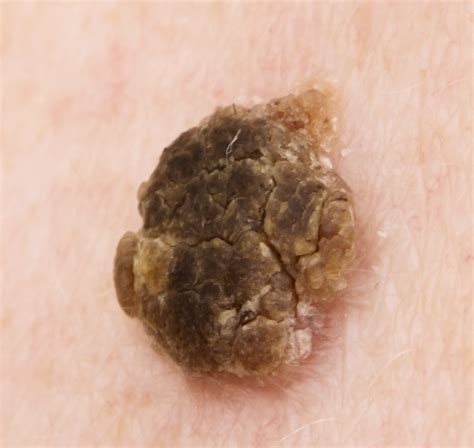 Seborrheic Keratosis Trillium Clinic Dermatology Chapel Hill