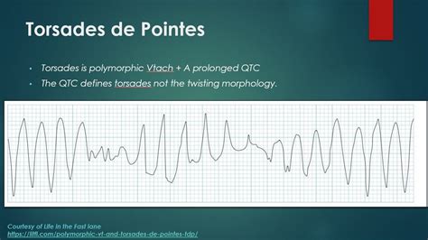 Torsades Management — Usf Emergency Medicine