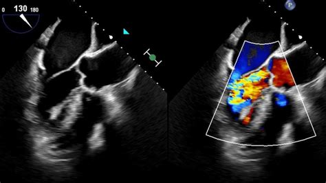 Aortic Insufficiency: Review and Current Therapies - Sentara