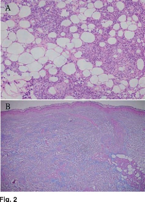 [pdf] Panniculitis In Adult Onset Dermatomyositis Report Of Two Cases And Review Of The