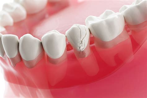 Emergency Dental Care Tips To Manage Chipped Cracked Teeth Encino