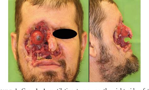 Figure 1 From Neglected Basal Cell Carcinomas In The 21st Century