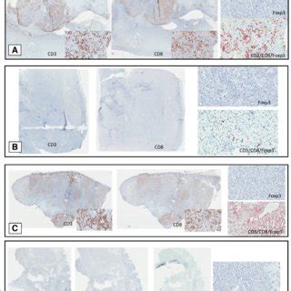 Immunohistochemistry Of Selected Cases With Cd Cd Foxp And Triple